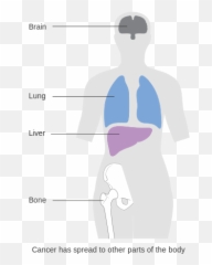Diagram Showing Stage 4 Breast Cancer Cruk 228 - Of Emoji