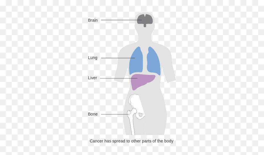 Diagram Showing Stage 4 Breast Cancer Cruk 228 - Stage 4 Of Breast Cancer Emoji,Emojis Are Cancer