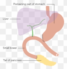 Diagram Showing How The Pancreas - Traverso Longmire Procedure Emoji,Whip Emoji Copy