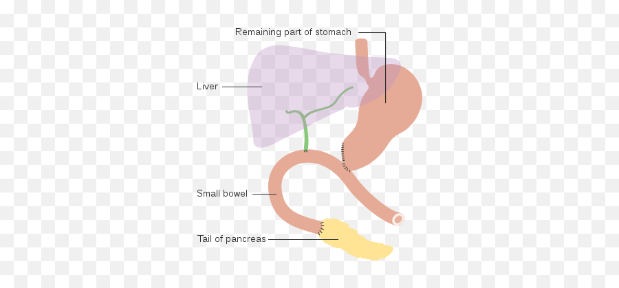Diagram Showing How The Pancreas - Traverso Longmire Procedure Emoji,Whip Emoji Copy