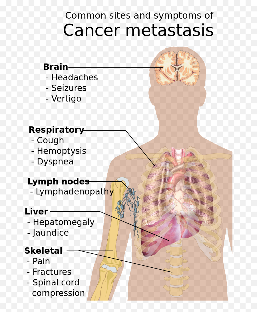 Symptoms Of Cancer Metastasis - Common Sites And Symptoms Of Cancer Metastasis Emoji,Shoulder Shrug Emoji
