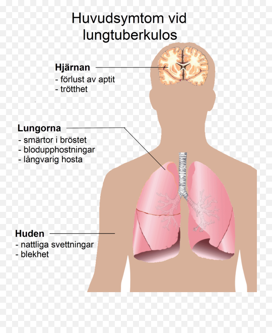 Pulmonary Tuberculosis Symptoms Swedish - Pulmonary Tuberculosis Symptoms Emoji,Bandaid Emoji