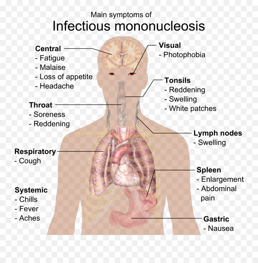 Main Symptoms Of Infectious Mononucleosis - Infectious Mononucleosis Emoji,Headache Emoji