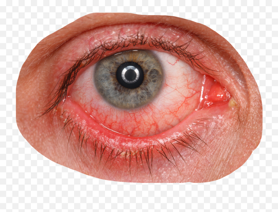 Eye Bloodshot Blood Redeye - Overwearing Contact Lenses Emoji,Bloodshot Eyes Emoji