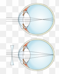 Myopia And Lens Correction - Concave Emoji