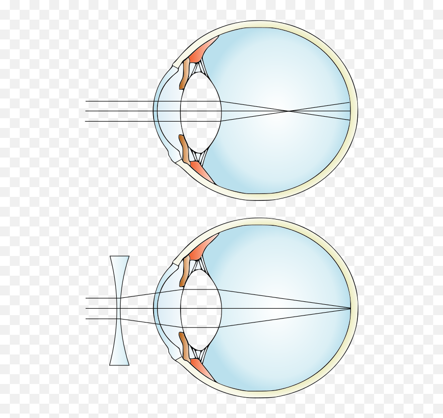 Myopia And Lens Correction - Concave Lens Myopia Emoji,Emotion Con