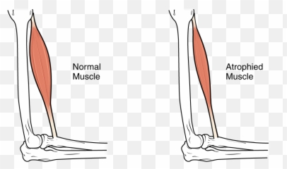 Download This Image Shows Muscle Atrophy - Hypertrophy Vs Emoji