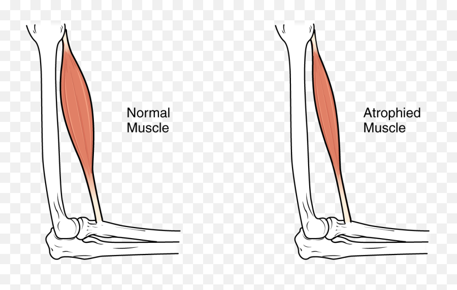Download This Image Shows Muscle Atrophy - Muscle Atrophy Muscle Hypertrophy Vs Atrophy Emoji,Muscles Emoji