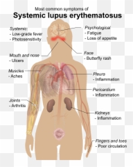 Symptoms Of Sle - Systemic Lupus Erythematosus Emoji,Muscles Emoji