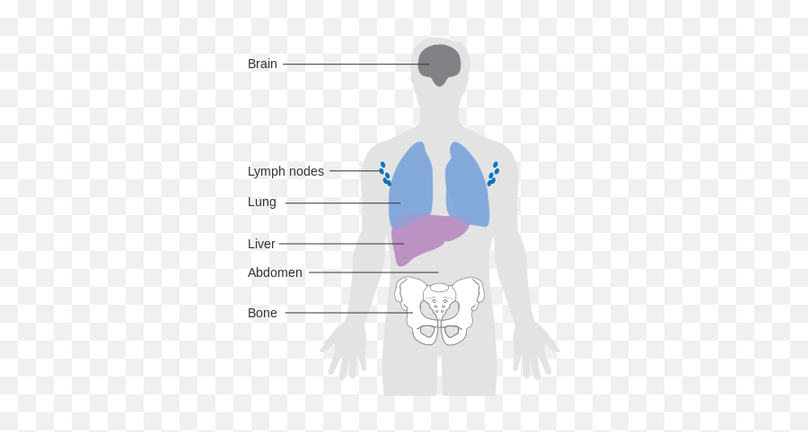 Diagram Showing The Most Common Places - Melanoma Human Diagram Emoji,Most Common Emojis