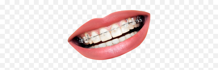 Braces Png And Vectors For Free - Mouth With Braces Png Emoji,Brace Face Emoji