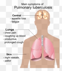 Pulmonary Tuberculosis Symptoms - Sintomas Produce El Sida Emoji,Emoji Trunk Or Treat