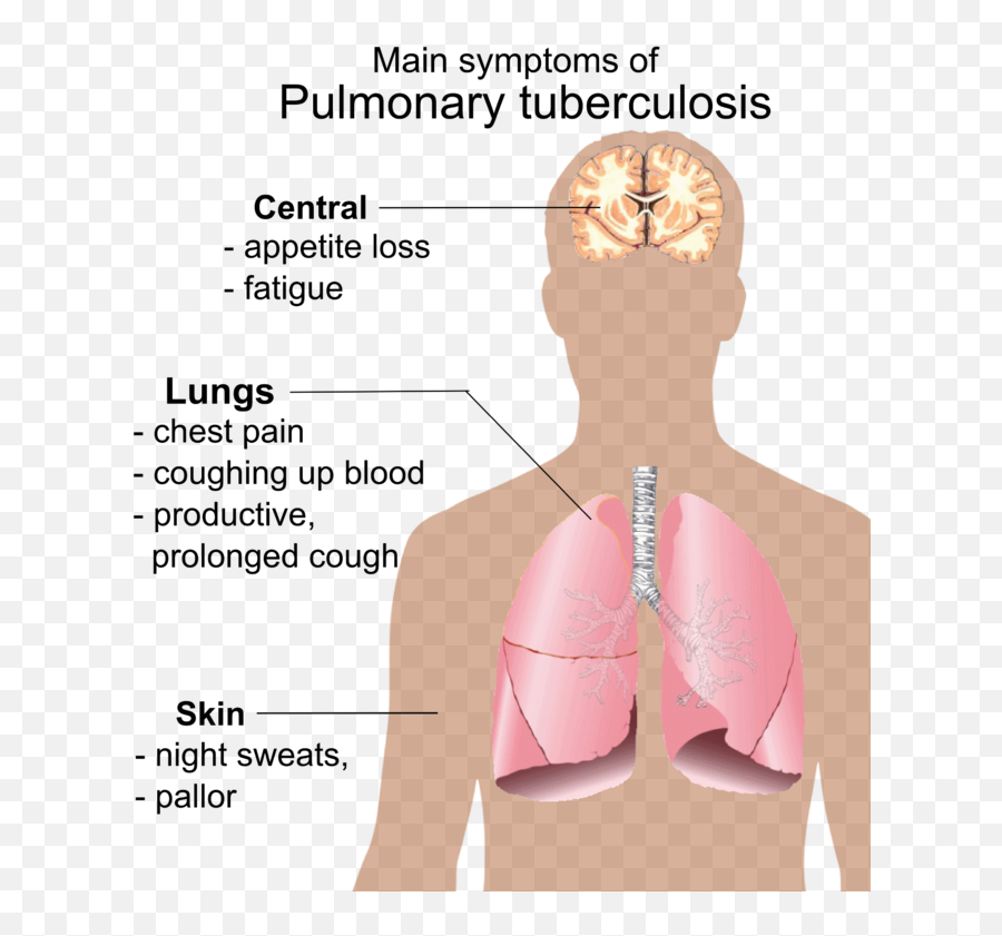 Pulmonary Tuberculosis Symptoms - Sintomas Produce El Sida Emoji,Emoji Trunk Or Treat