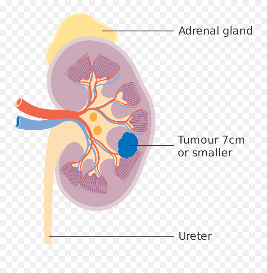 Stage 1 Kidney Cancer Cruk 192 - Illustration Emoji,Emoji Cancer