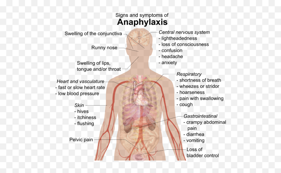 Signs And Symptoms Of Anaphylaxis - Allergy Anaphylaxis Emoji,Bat Emoji Copy And Paste