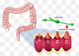 Endo Clip Colon Transparent Png - Pt4a Colon Cancer Emoji,Colonoscopy Emoji
