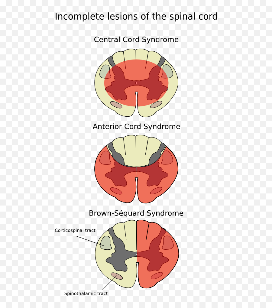 Cord - Spinal Cord Syndrome Emoji,Moving Tongue Emoji